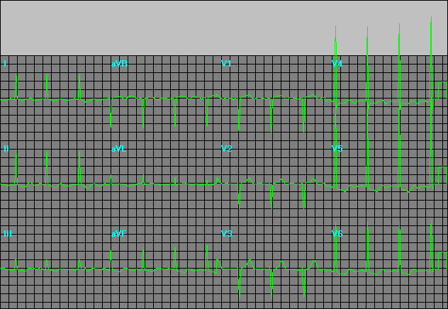 Lvh Ekg Criteria