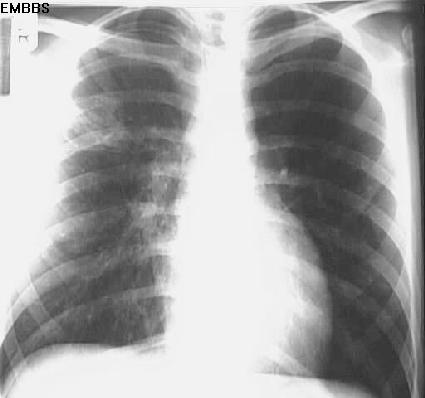 Rul Pneumonia