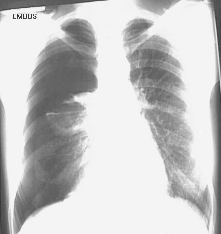 Emphysema X Ray. good x-ray cxr Open