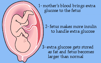 Understanding Gestational Diabetes