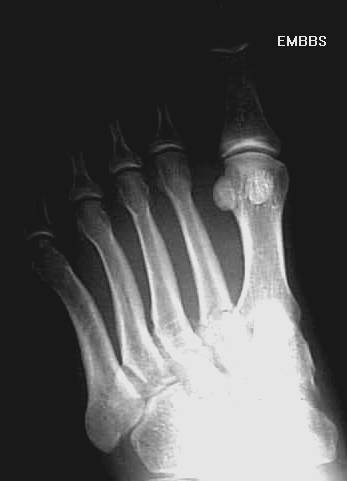 cpt orif 5th metatarsal fracture cpt orif 5th metatarsal fracture