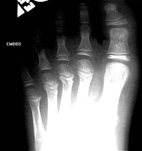 right fourth metatarsal stress fracture icd 10