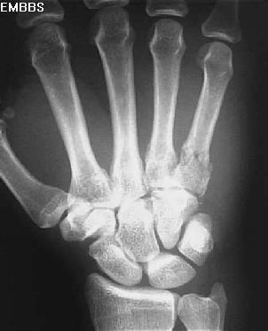 Metacarpal Fracture Xray