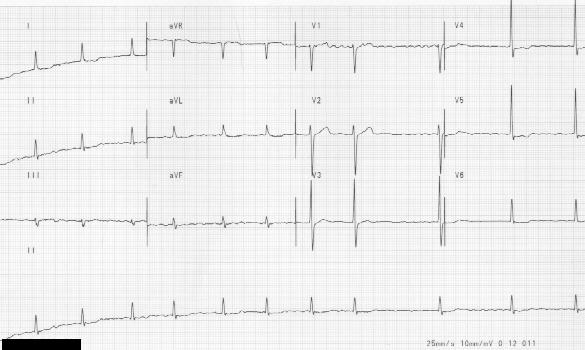 #18 Totally irregular rythm with absent P waves of atrial fibrillation .